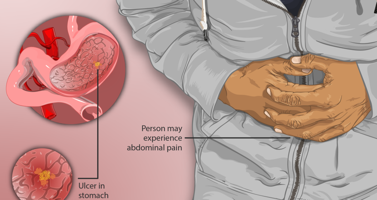 What Is The Treatment Of Gastric Ulcer