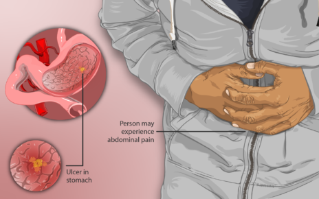 What Is The Treatment Of Gastric Ulcer