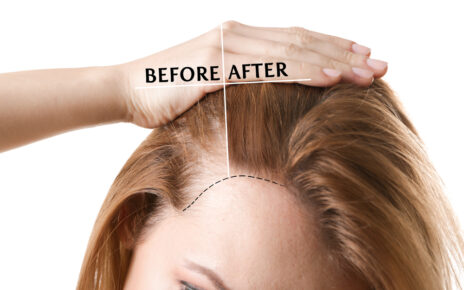 hair transplant