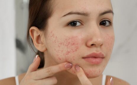 ways to control acne breakouts naturally