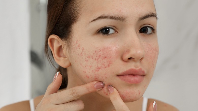 ways to control acne breakouts naturally