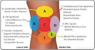 Knee Pain Location Chart