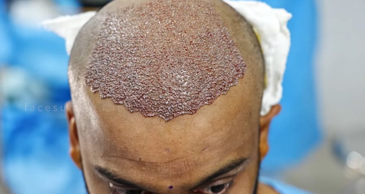 Hair Transplant