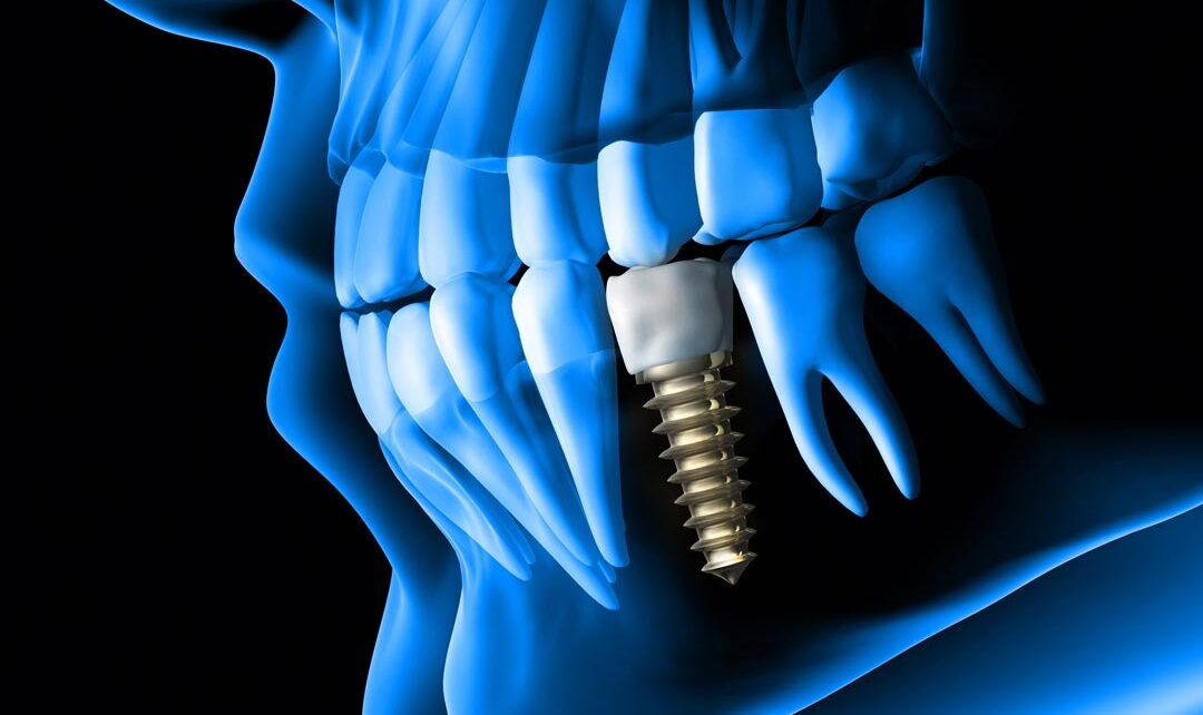 Affordable Dental Implants in Dubai