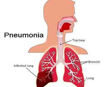 Pneumonia