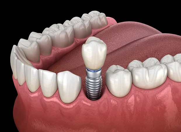 Dental Implants In Abu Dhabi