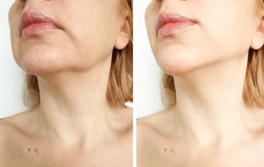 Non-surgical skin tightening