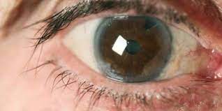 lasik laser eye surgery