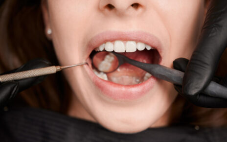 gum depigmentation