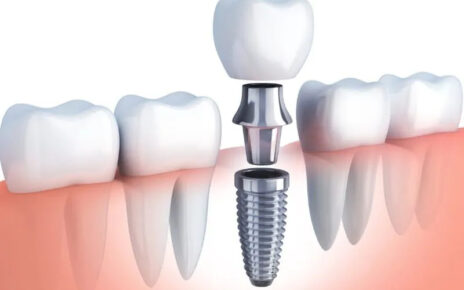 dental-implants