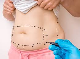 Tummy Tuck in Dubai