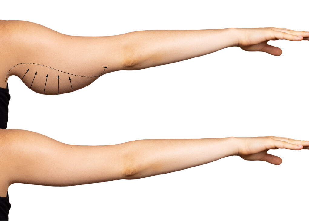 Loose Skin Arm Surgery in Islamabad