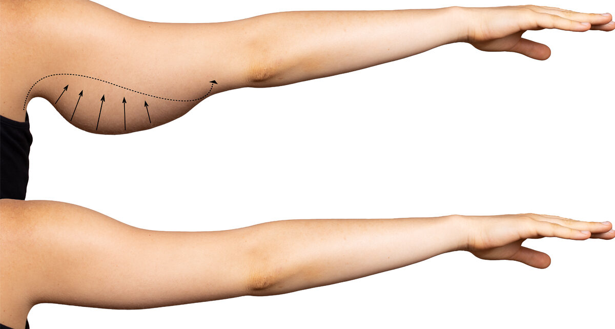 Loose Skin Arm Surgery in Islamabad