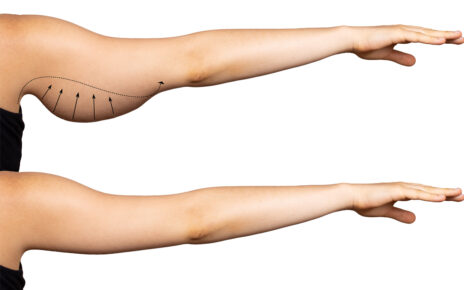 Loose Skin Arm Surgery in Islamabad