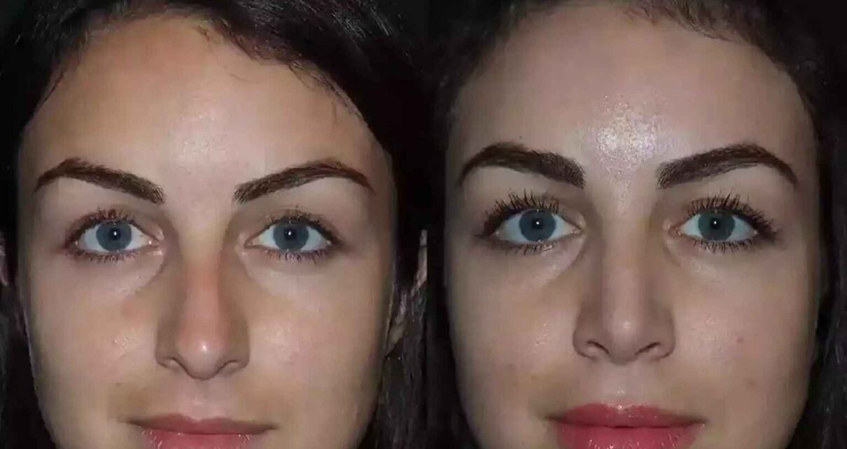 Septoplasty in Dubai