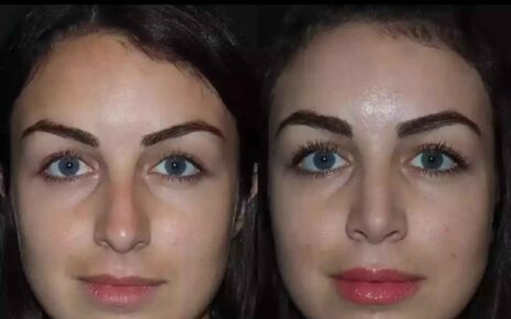 Septoplasty in Dubai