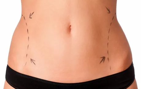 Liposuction surgery in Dubai