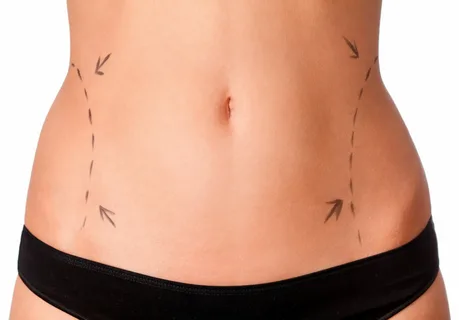Liposuction surgery in Dubai
