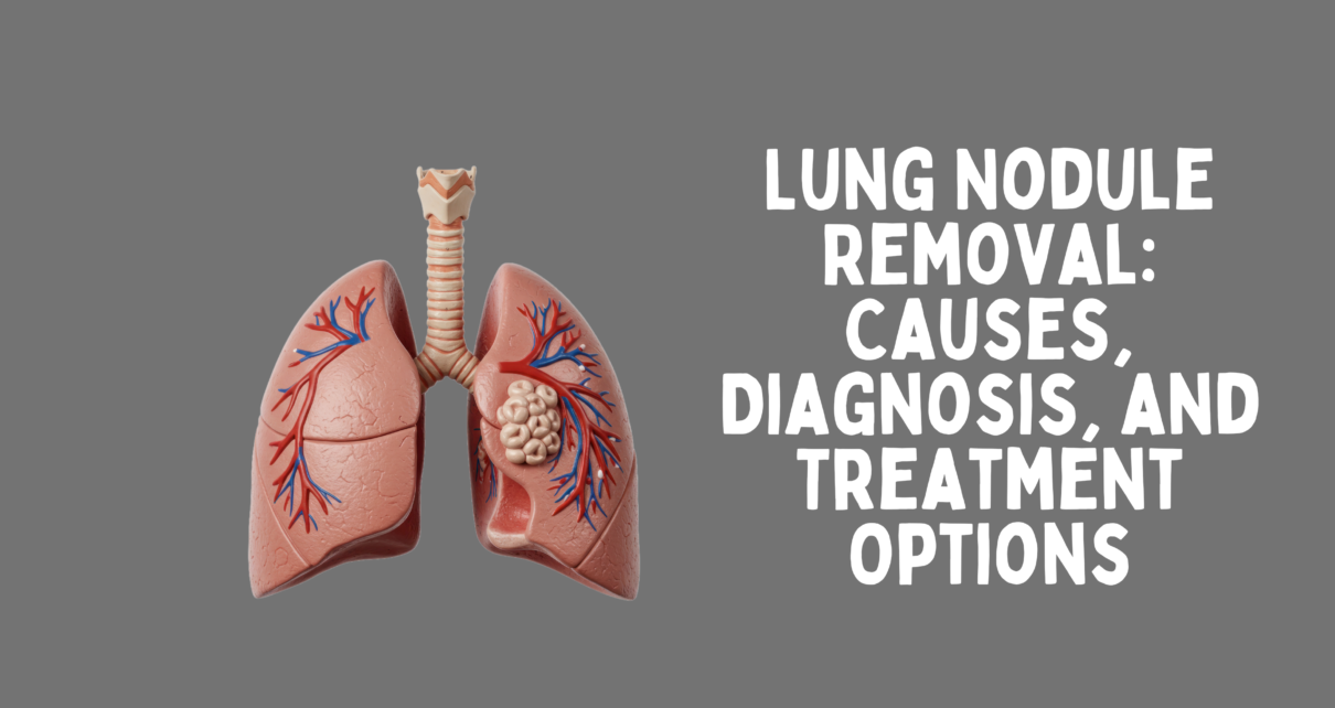 Lung Nodule Removal: Causes, Diagnosis, and Treatment Options