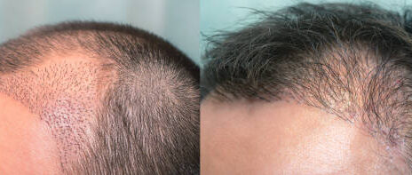4000 or 5000 grafts hair transplant in Riyadh