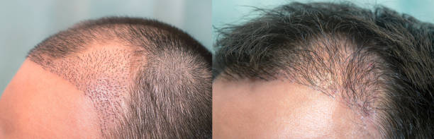 4000 or 5000 grafts hair transplant in Riyadh