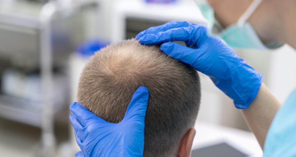 Hair transplant in Riyadh