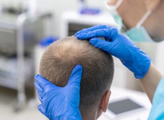 Hair transplant in Riyadh