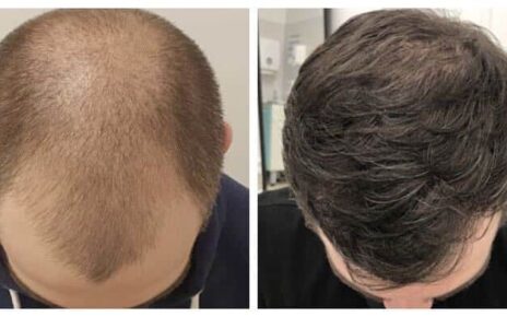 Hair transplant in Riyadh