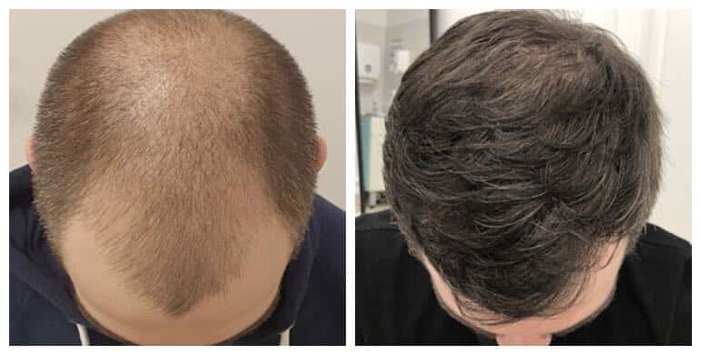 Hair transplant in Riyadh