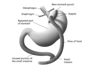 Debunking Common Myths About Gastric Bypass Surgery in Islamabad