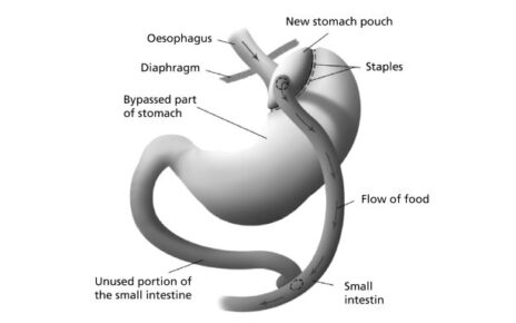 Debunking Common Myths About Gastric Bypass Surgery in Islamabad