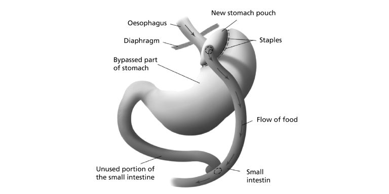Debunking Common Myths About Gastric Bypass Surgery in Islamabad