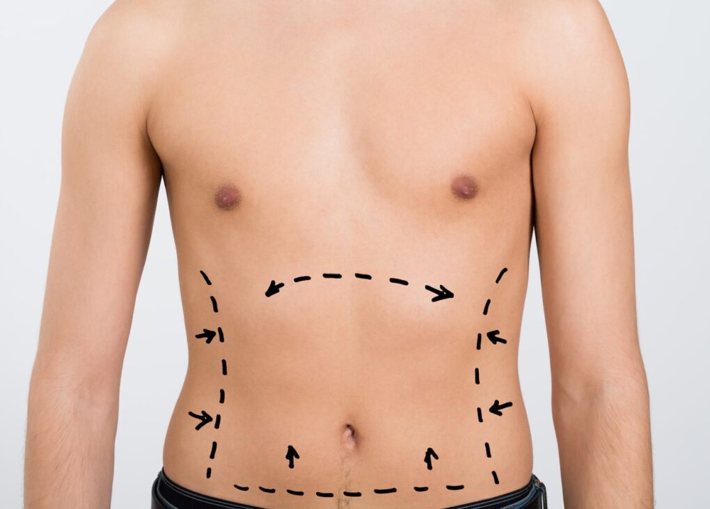 liposuction in Islamabad