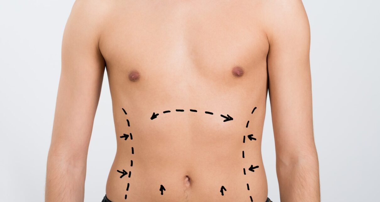 liposuction in Islamabad