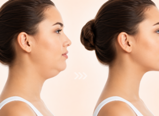 Double Chin Removal