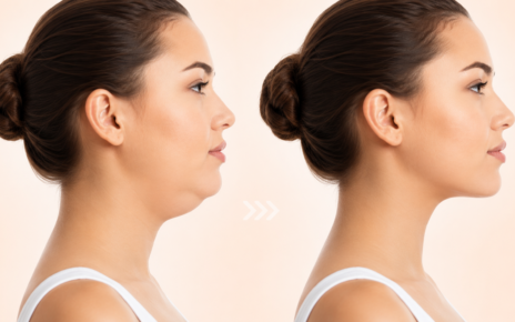 Double Chin Removal